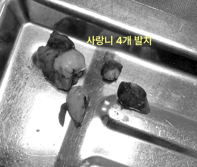 발치된 사랑니 4개가 쟁반 위에 놓여 있는 모습.