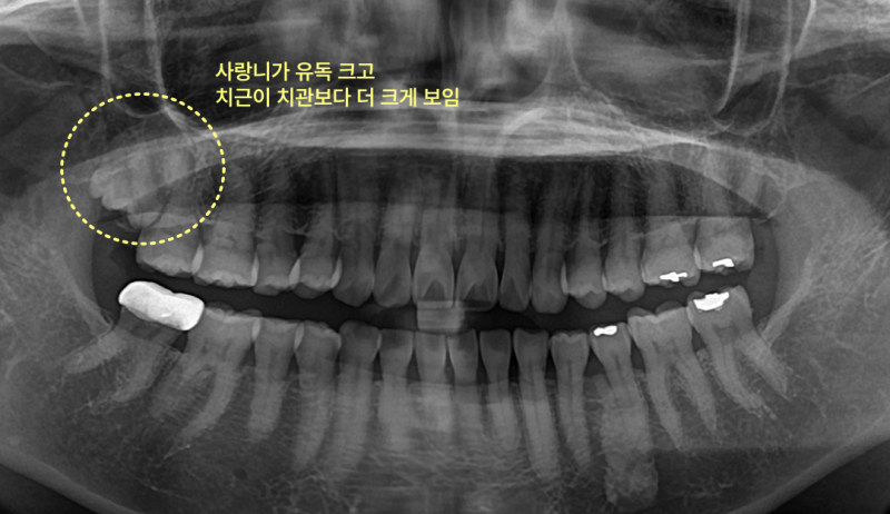 엑스레이 사진에 치관보다 큰 사랑니가 노랗게 표시되어 있다.