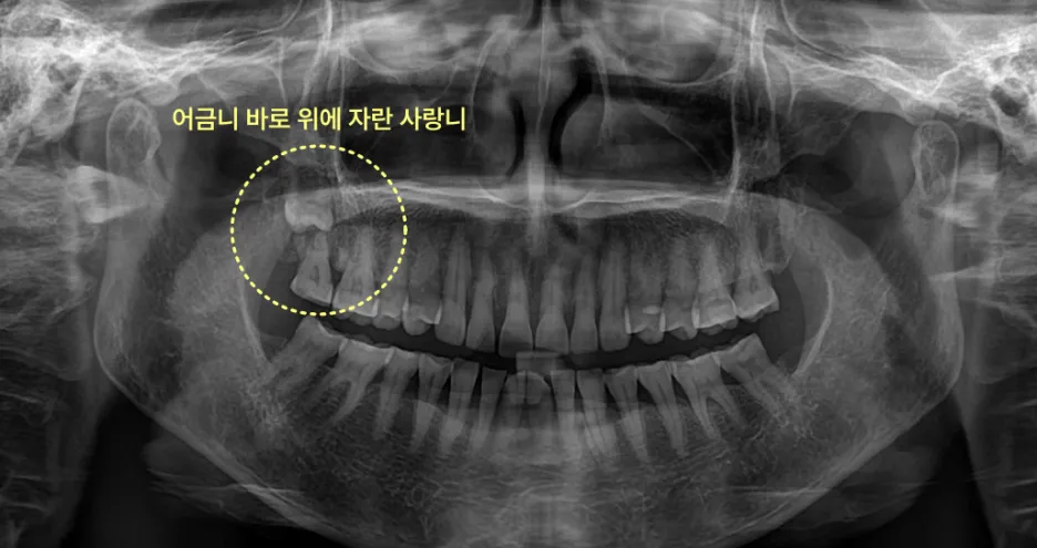 어금니 바로 위에 자란 사랑니 X-ray