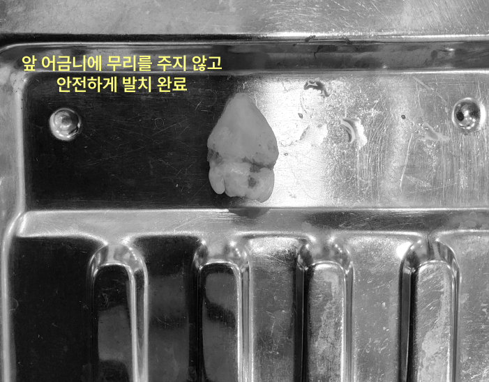스테인리스 쟁반 위에 발치된 사랑니가 놓여 있다.