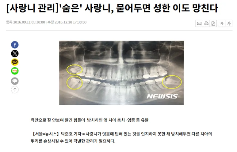 인천사랑니치과 발치 중 턱뼈 골절 가능성은? 4 사랑니 관리 기사
