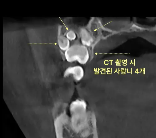 CT 촬영 사진에서 4개의 사랑니가 노란색 화살표로 표시되어 있다.