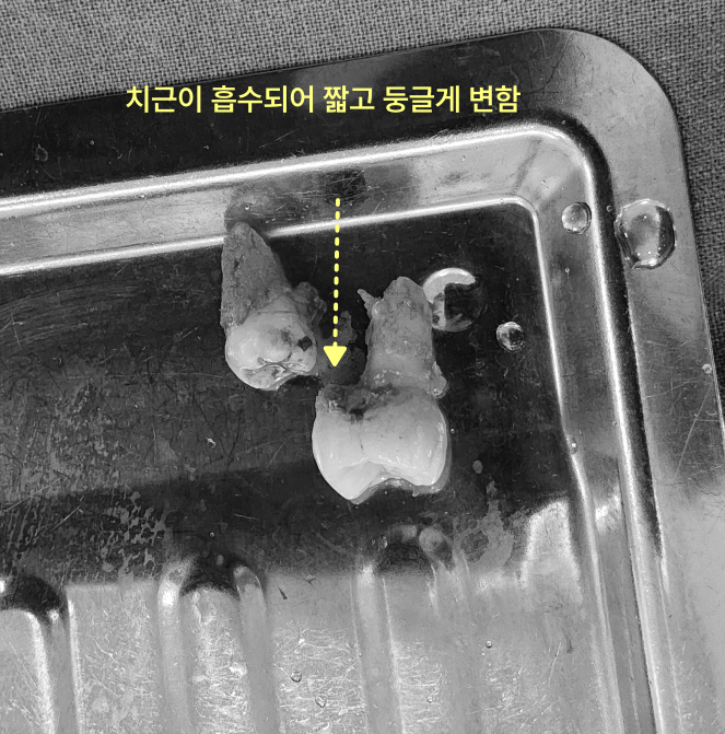 치근이 흡수되어 짧고 둥글게 변한 발치된 치아 사진