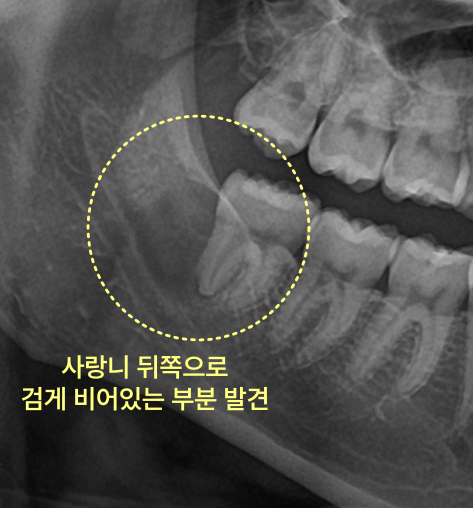 사랑니 뒤쪽 검게 비어있는 부분 발견 엑스레이