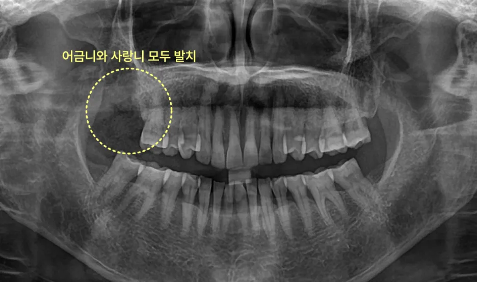 어금니와 사랑니 모두 발치 후 X-ray