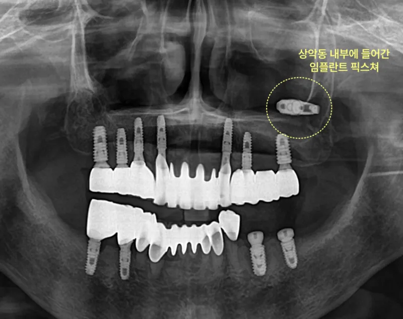 상악동 내부에 들어간 임플란트 픽스처를 보여주는 엑스레이.