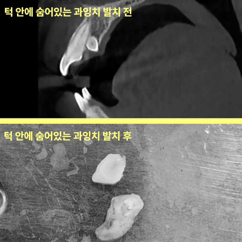 과잉치, 왜 구강악안면외과 전문의에게 맡겨야 할까요? 11 과잉치, 꼭 뽑아야 할까요? 구강외과 전문의의 판단 기준