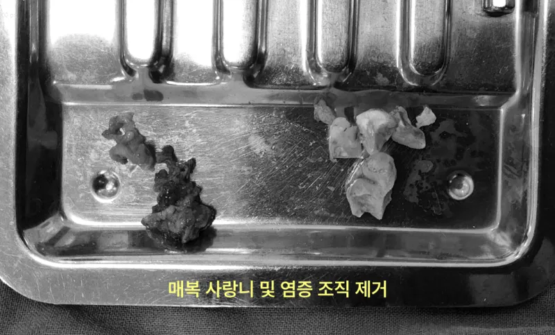 매복 사랑니와 염증 조직을 제거한 모습이 담긴 수술 도구 트레이.