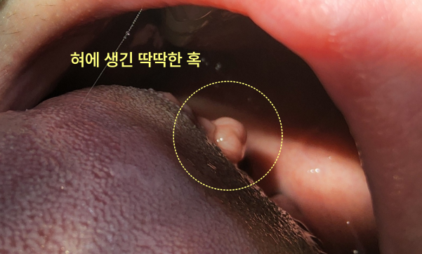 혀에 생긴 딱딱한 혹 클로즈업 사진
