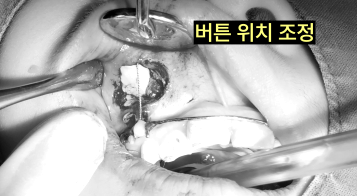 매복니 치료에 구강악안면외과 전문의가 필요한 경우 8 구강 내 수술 사진으로 버튼 위치를 조정하는 모습이다.