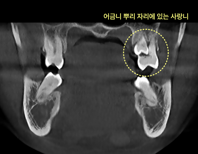 CT 사진에서 어금니 뿌리 자리에 있는 사랑니가 노란색 원으로 표시되어 있다.