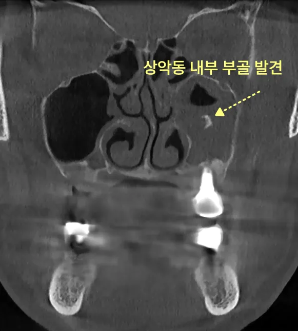 상악동 내부 부골이 발견된 CT 사진