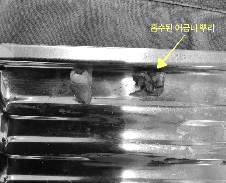 흡수된 어금니 뿌리 사진