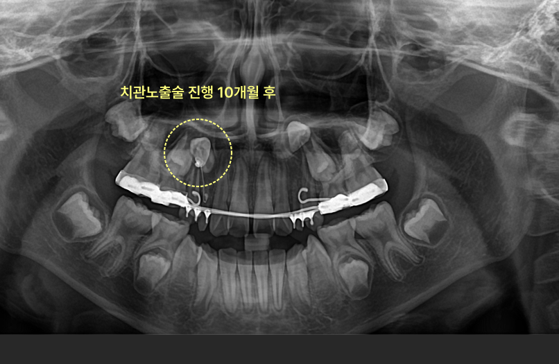 매복니 치료에 구강악안면외과 전문의가 필요한 경우 6 치관노출술 10개월 후 엑스레이 사진에 교정 장치가 보인다.