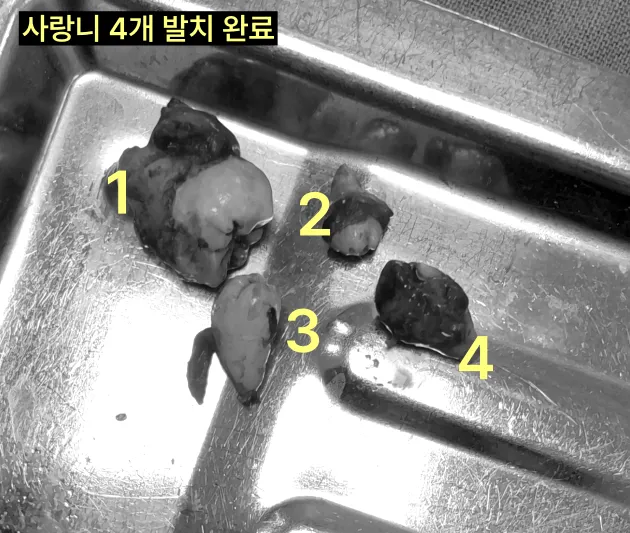 사랑니가 4개 이상 매복될 수도 있나요? 8 발치된 4개의 사랑니가 담긴 트레이 사진