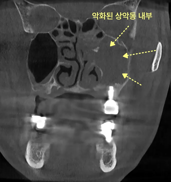 악화된 상악동 내부를 보여주는 CT 사진