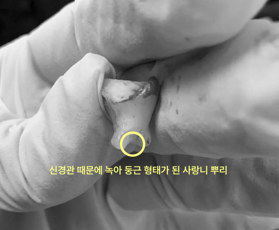 신경과 가까운 사랑니를 방치하면 어떻게 되나요? 7 신경관 때문에 뿌리가 녹아 둥근 형태가 된 사랑니