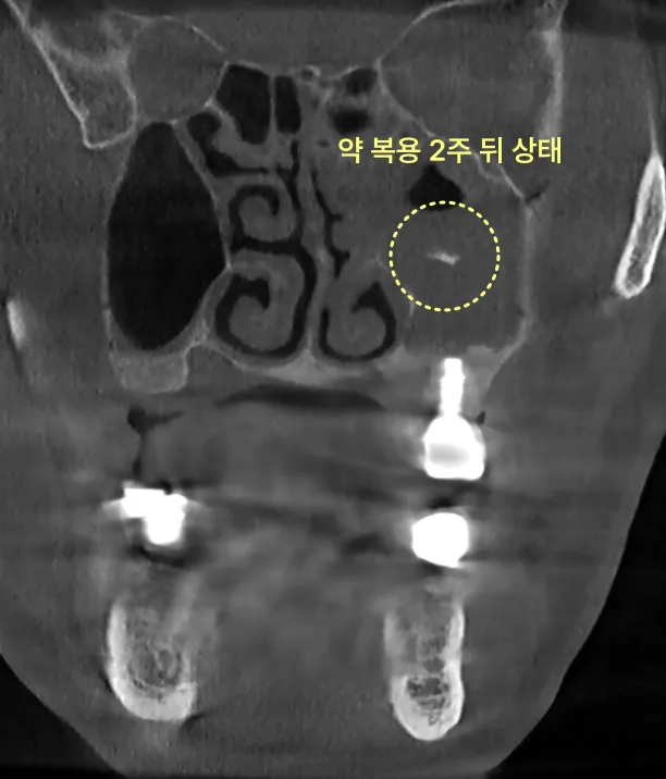 약 복용 2주 후 상태를 보여주는 CT 사진.