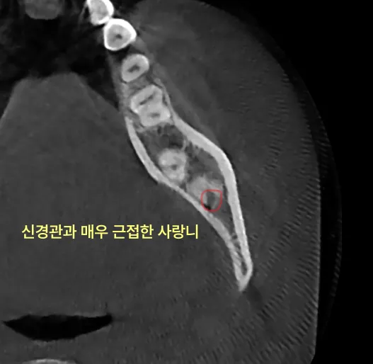 신경과 가까운 사랑니를 방치하면 어떻게 되나요? 9 신경관과 매우 근접한 사랑니 CT 사진