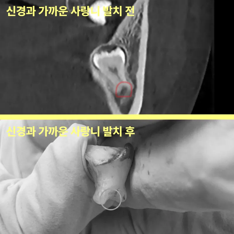 신경과 가까운 사랑니를 방치하면 어떻게 되나요? 11 신경과 가까운 사랑니, 방치하면 더 복잡해집니다