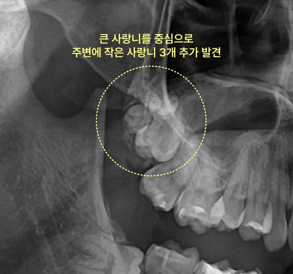 사랑니가 4개 이상 매복될 수도 있나요? 5 큰 사랑니 주변에 작은 사랑니 3개가 추가로 발견된 엑스레이 사진