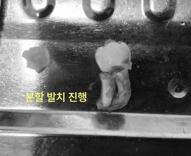 인천사랑니치과 발치 중 턱뼈 골절 가능성은? 8 분할 발치된 사랑니