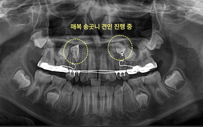 아이 송곳니가 안 나옵니다, 기다려도 될까요? 9 매복 송곳니 견인 진행 중 X-ray