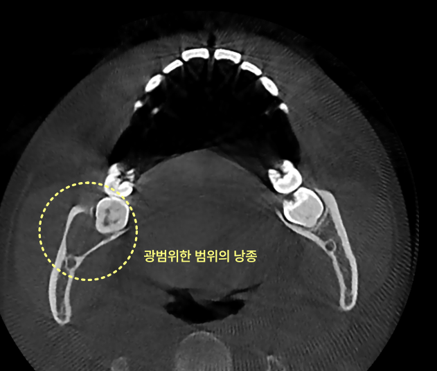 사랑니 주변에 광범위한 낭종이 노란 점선 원으로 표시된 CT 사진.