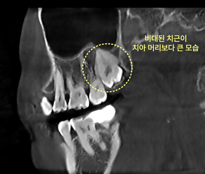 CT 사진에 치아 머리보다 큰 비대된 치근이 노랗게 표시되어 있다.