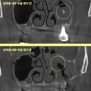 인천임플란트 실패하면 이렇게 돼요-사진 有