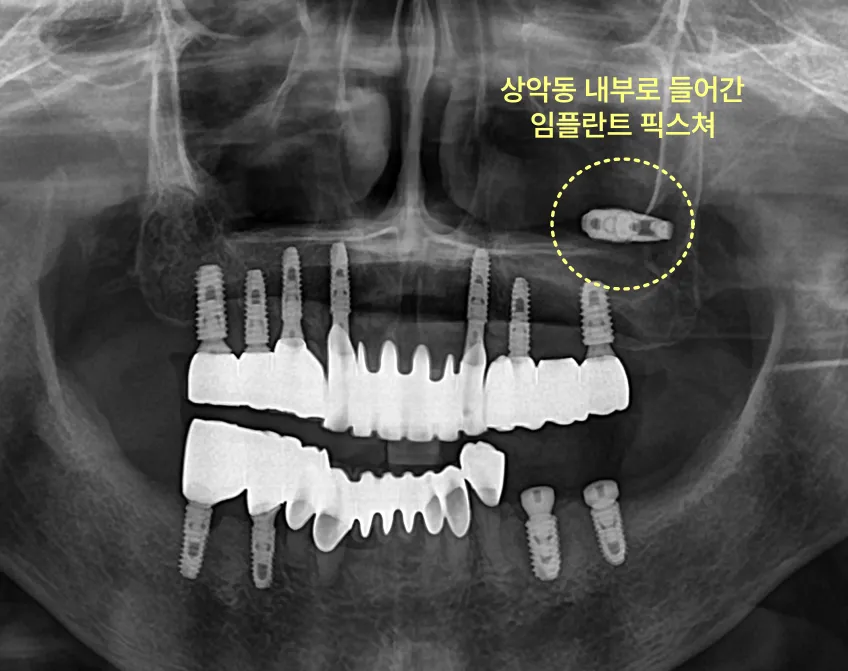 상악동 내부에 들어간 임플란트 픽스처를 보여주는 엑스레이 사진