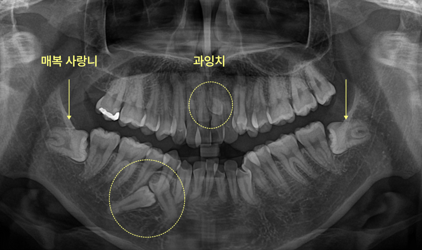 과잉치, 왜 구강악안면외과 전문의에게 맡겨야 할까요? 5 매복 사랑니와 과잉치가 표시된 엑스레이 사진