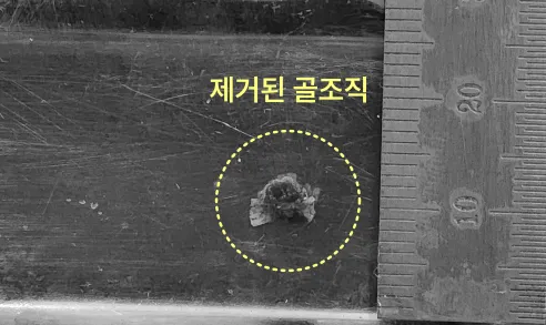 인천임플란트 실패하면 이렇게 돼요-사진 有
