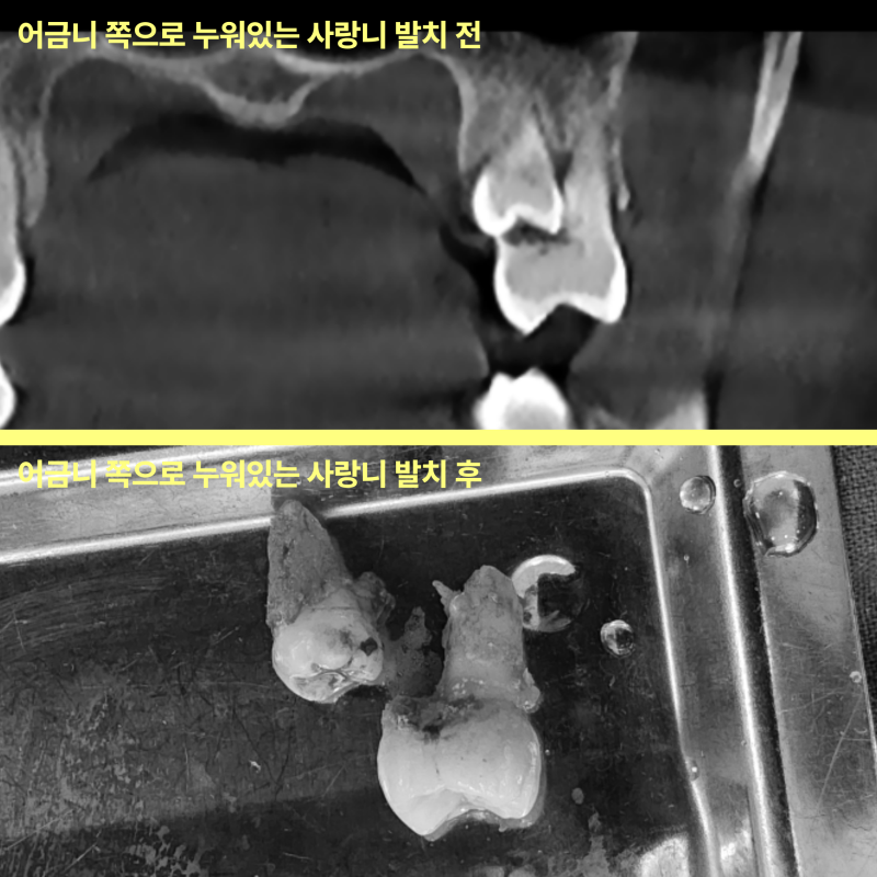 상단은 어금니 쪽으로 누워있는 사랑니 발치 전 CT 사진, 하단은 발치 후 어금니와 사랑니가 쟁반에 놓인 사진.