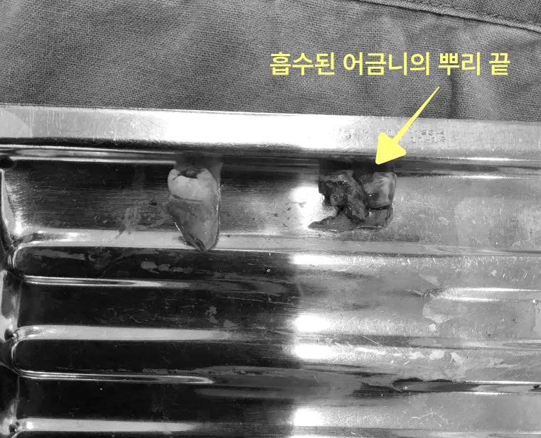 흡수된 어금니 뿌리 끝을 보여주는 발치된 치아 사진