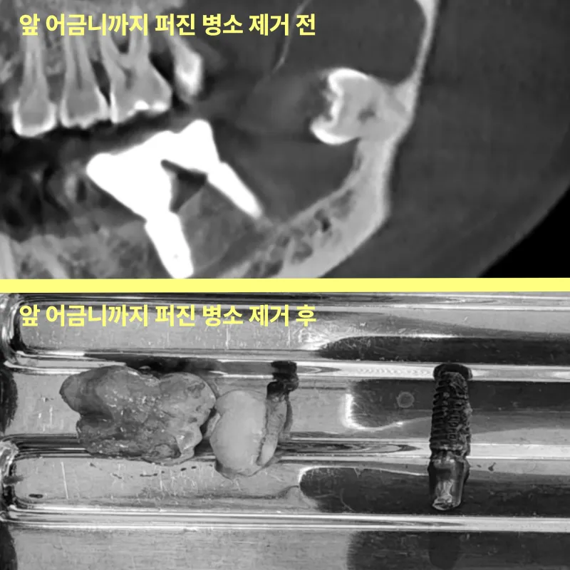 사랑니를 방치하면 앞 어금니까지 뽑아야 하나요? 9 사랑니 병소 제거 전후 비교 사진