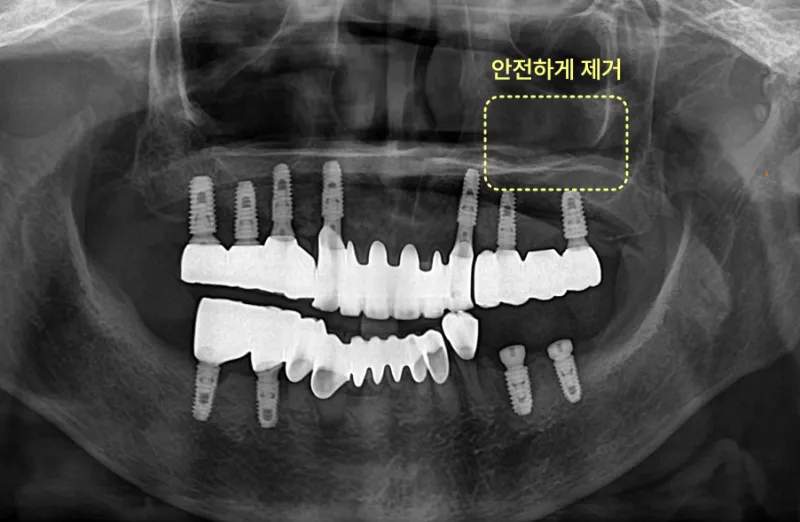 임플란트 픽스처가 안전하게 제거된 후의 엑스레이.