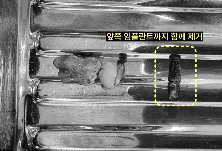 사랑니를 방치하면 앞 어금니까지 뽑아야 하나요? 7 제거된 사랑니, 병소 조직, 그리고 임플란트