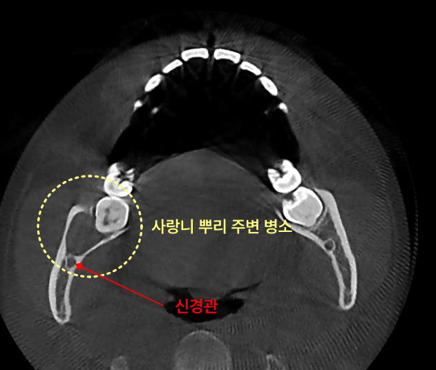 사랑니 뿌리 주변 병소와 신경관 CT 사진