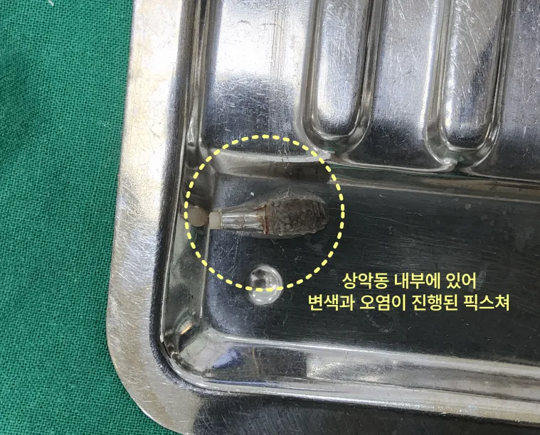 상악동 내부에서 변색되고 오염된 픽스처.