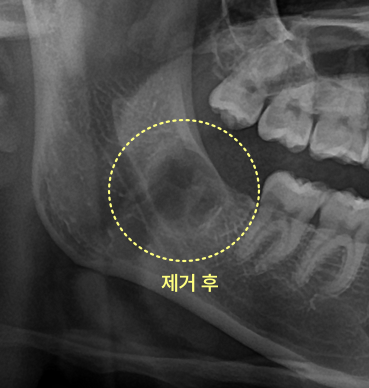사랑니와 낭종 제거 후 턱뼈 엑스레이 사진.