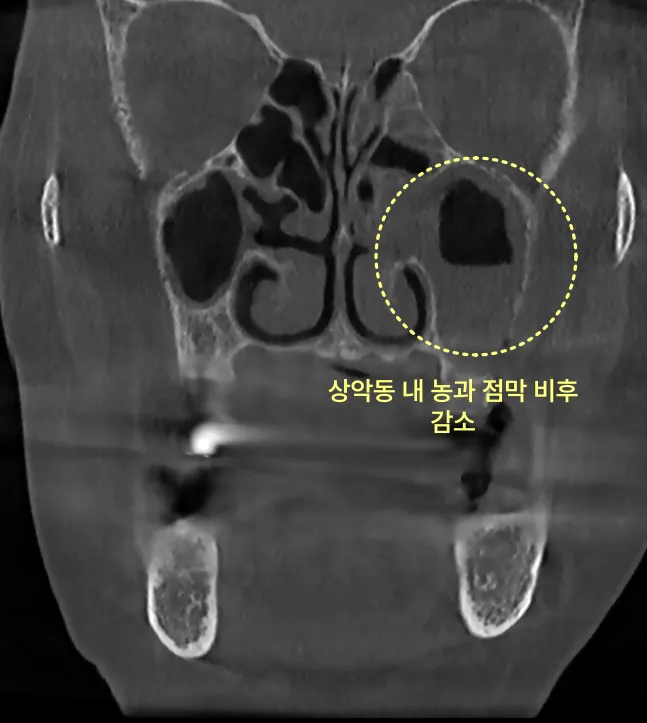구월동임플란트가 상악동 속으로 들어갈 수 있다?