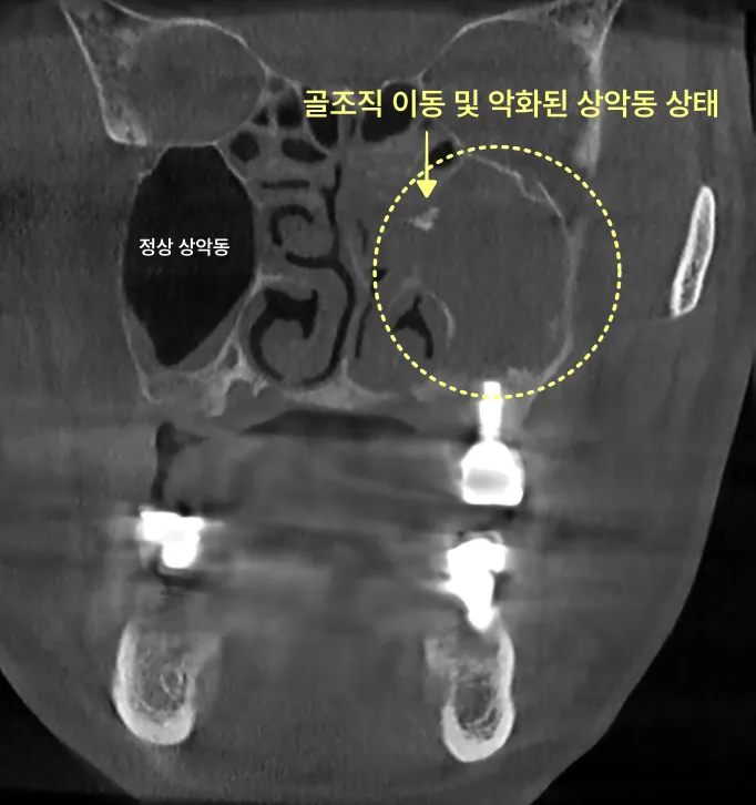 골조직 이동 및 악화된 상악동 상태를 보여주는 CT 사진.