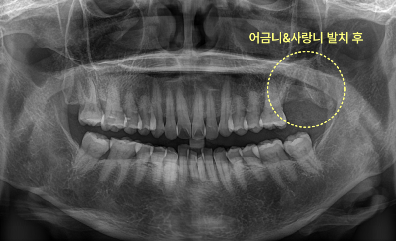 어금니와 사랑니 발치 후 엑스레이 사진