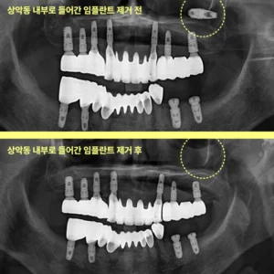구월동임플란트가 상악동 속으로 들어갈 수 있다?