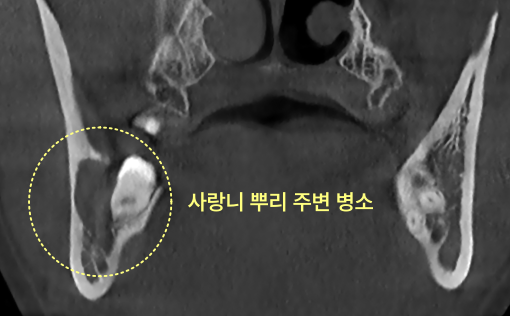 사랑니 뿌리 주변 병소 CT 사진