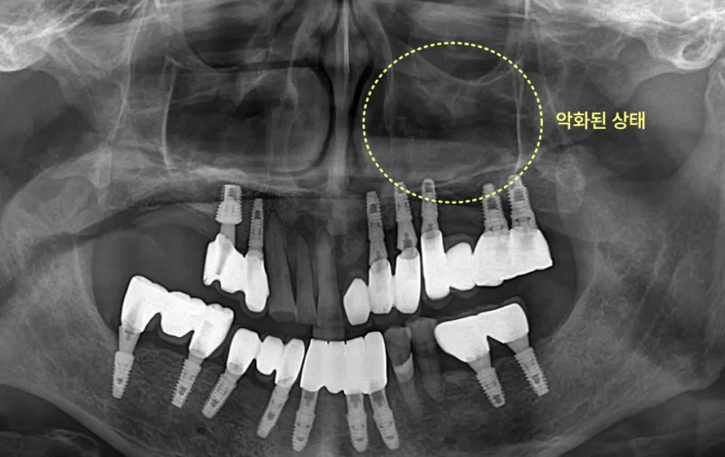 악화된 상태를 보여주는 치아 엑스레이 사진.