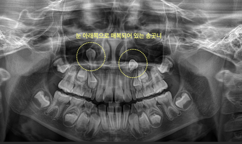 아이 송곳니가 안 나옵니다, 기다려도 될까요? 4 눈 아래쪽으로 매복되어 있는 송곳니 X-ray