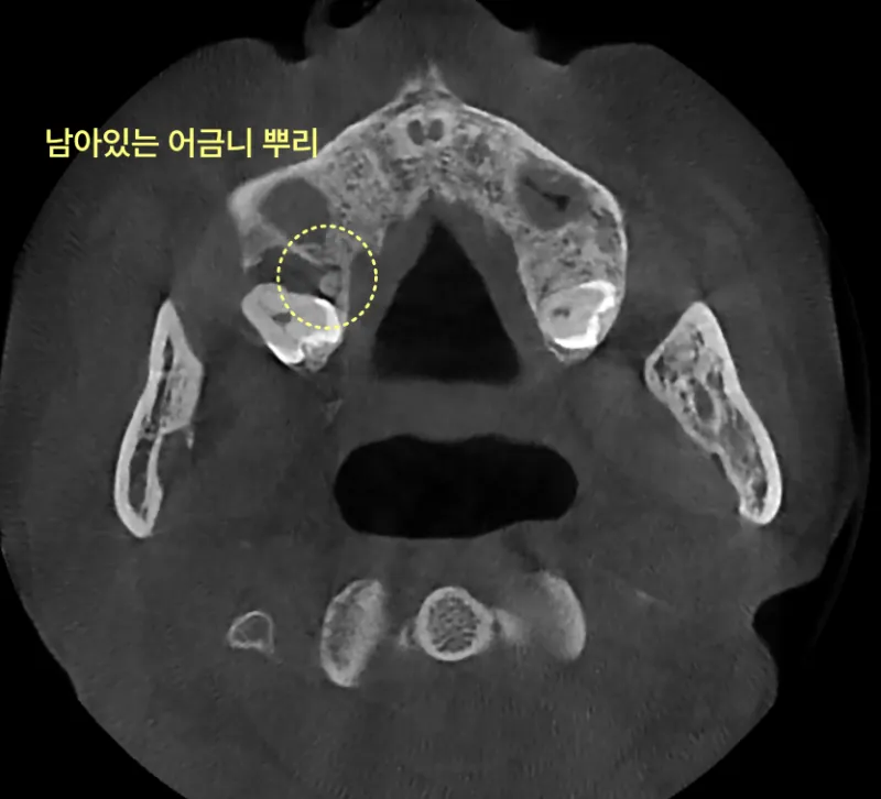 남아있는 어금니 뿌리를 보여주는 CT 스캔 사진.