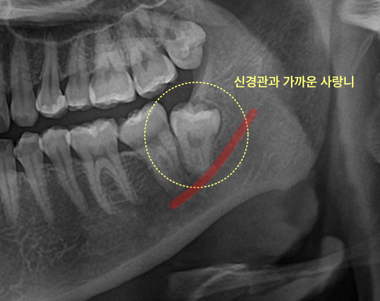 사랑니 뿌리가 신경과 가까우면 발치를 어떻게 하나요? 5 신경관과 가까운 사랑니 엑스레이 사진